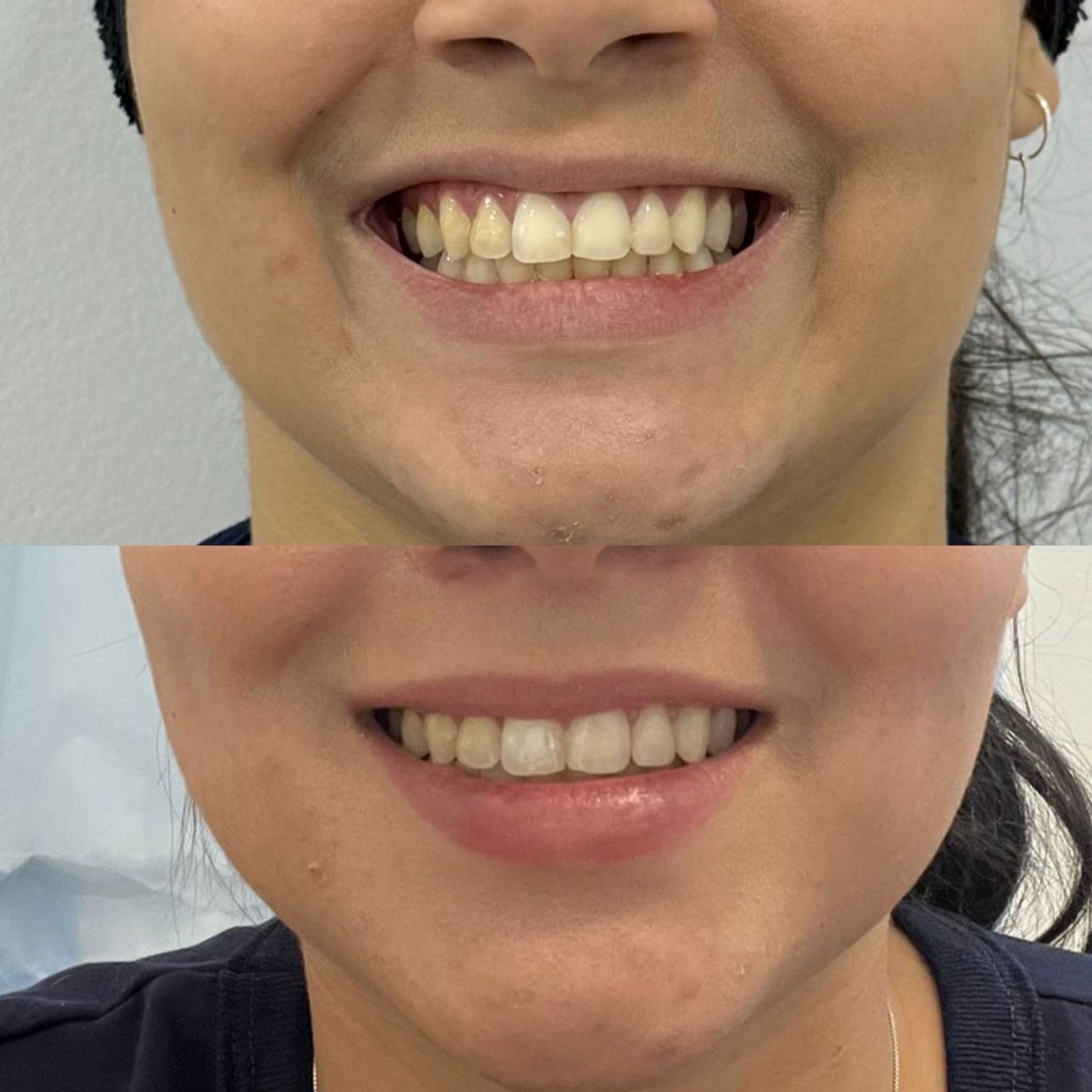 Antes e depois de botox para sorriso gengival