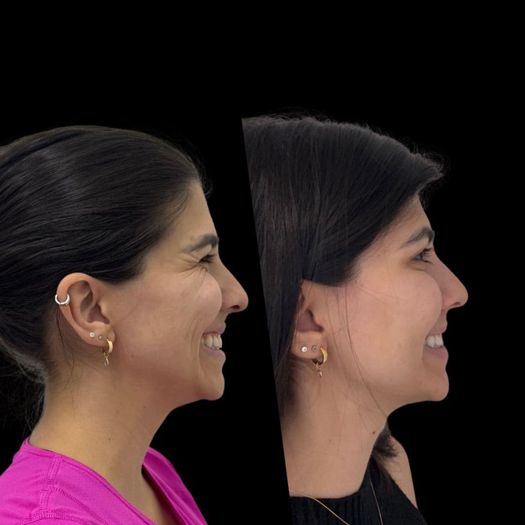 Antes e depois de botox na região dos olhos