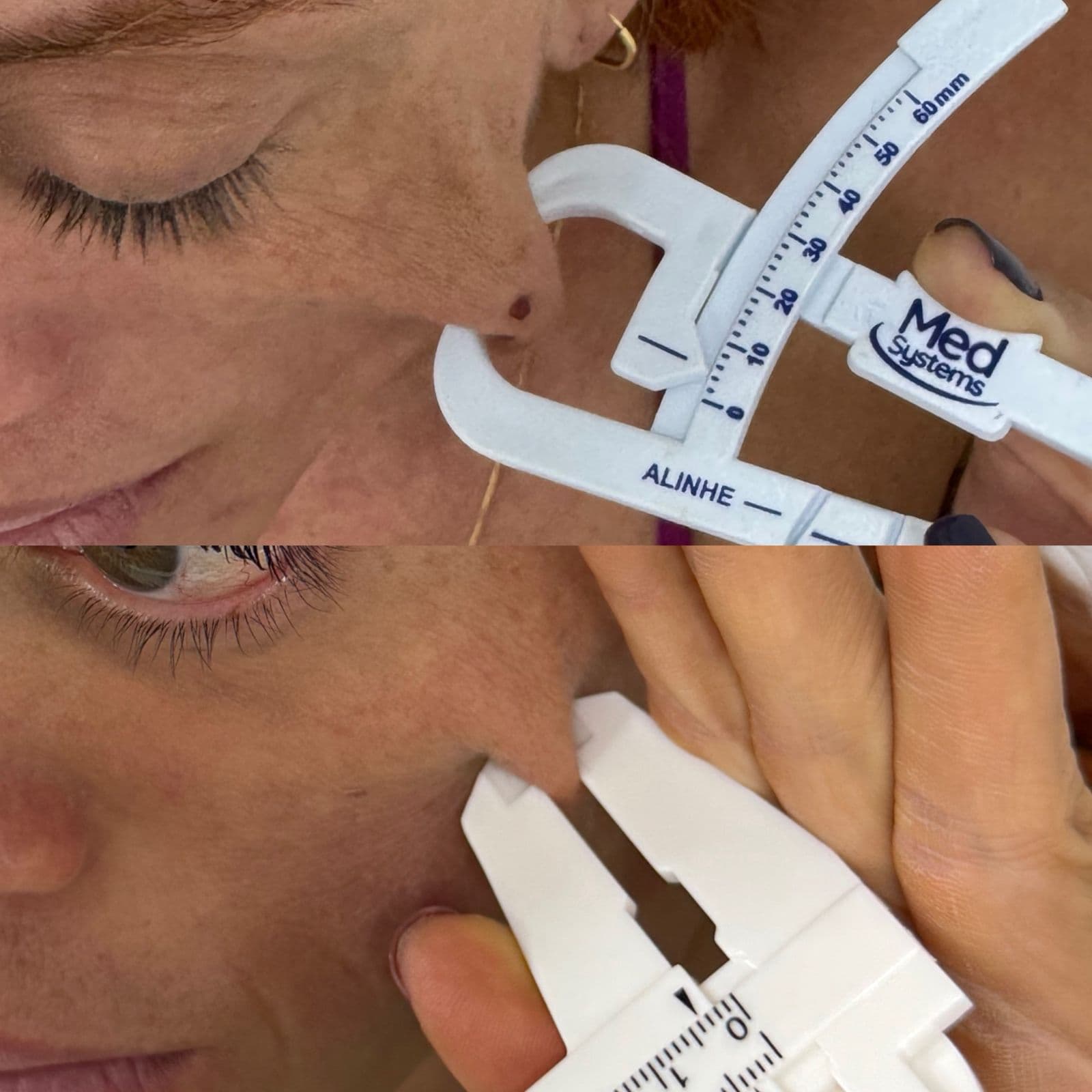Antes e depois de estímulo de colágeno com bioestimulador e Ultraformer
