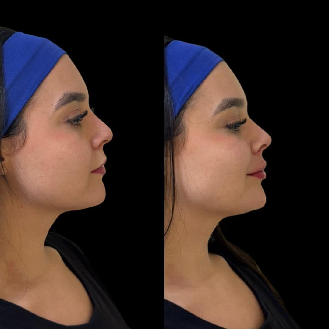 Antes e depois de perfilplastia com preenchimento labial, rinomodelação e mento