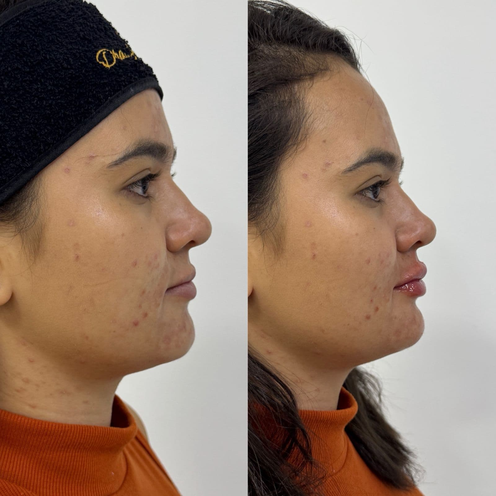 Antes e depois de preenchimento labial e mento (queixo)