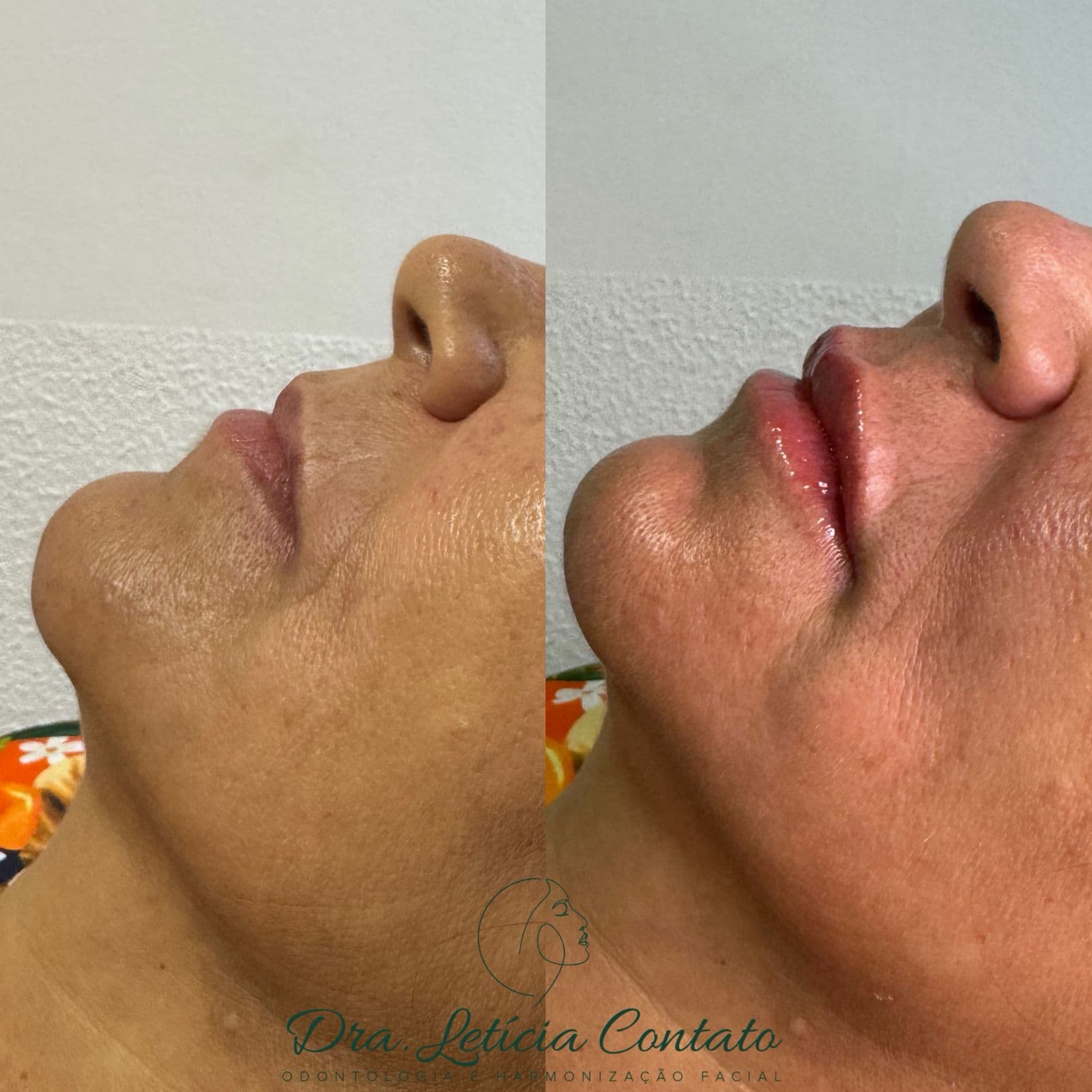 Antes e depois de preenchimento labial