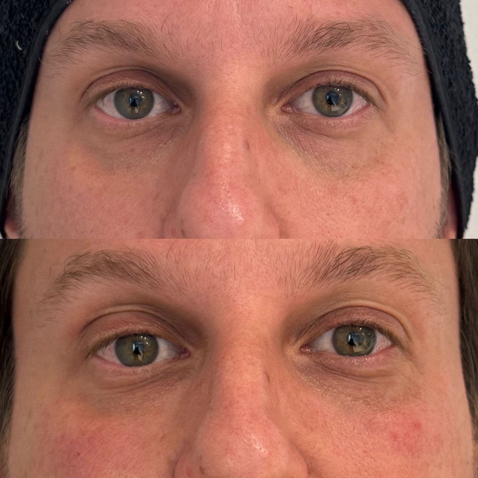 Antes e depois de preenchimento de olheiras