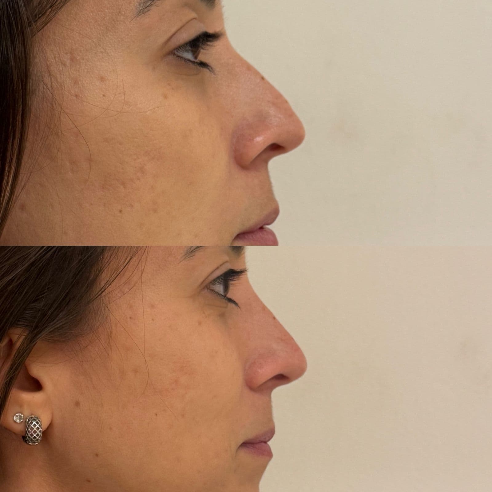 Antes e depois de rinomodelação