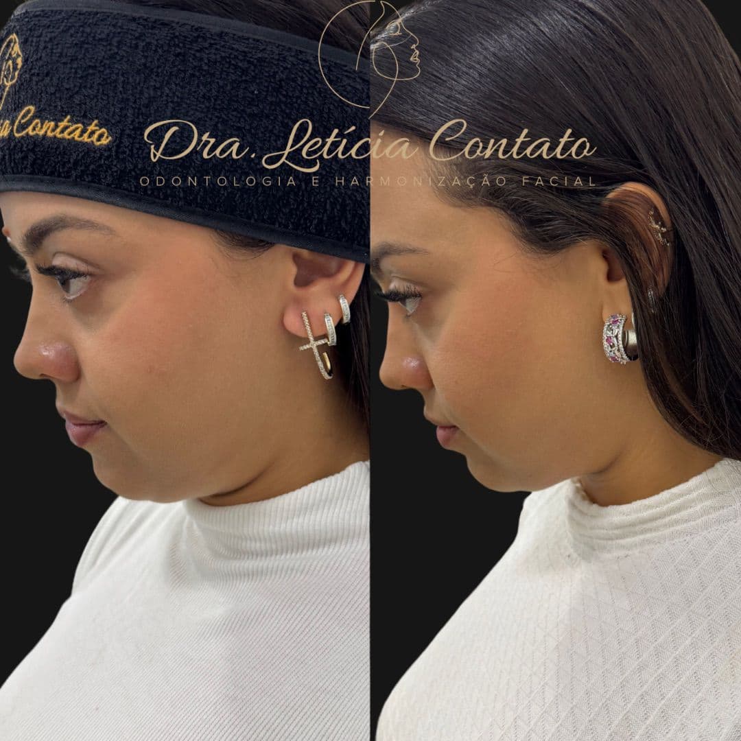 Antes e depois de Ultraformer para papada