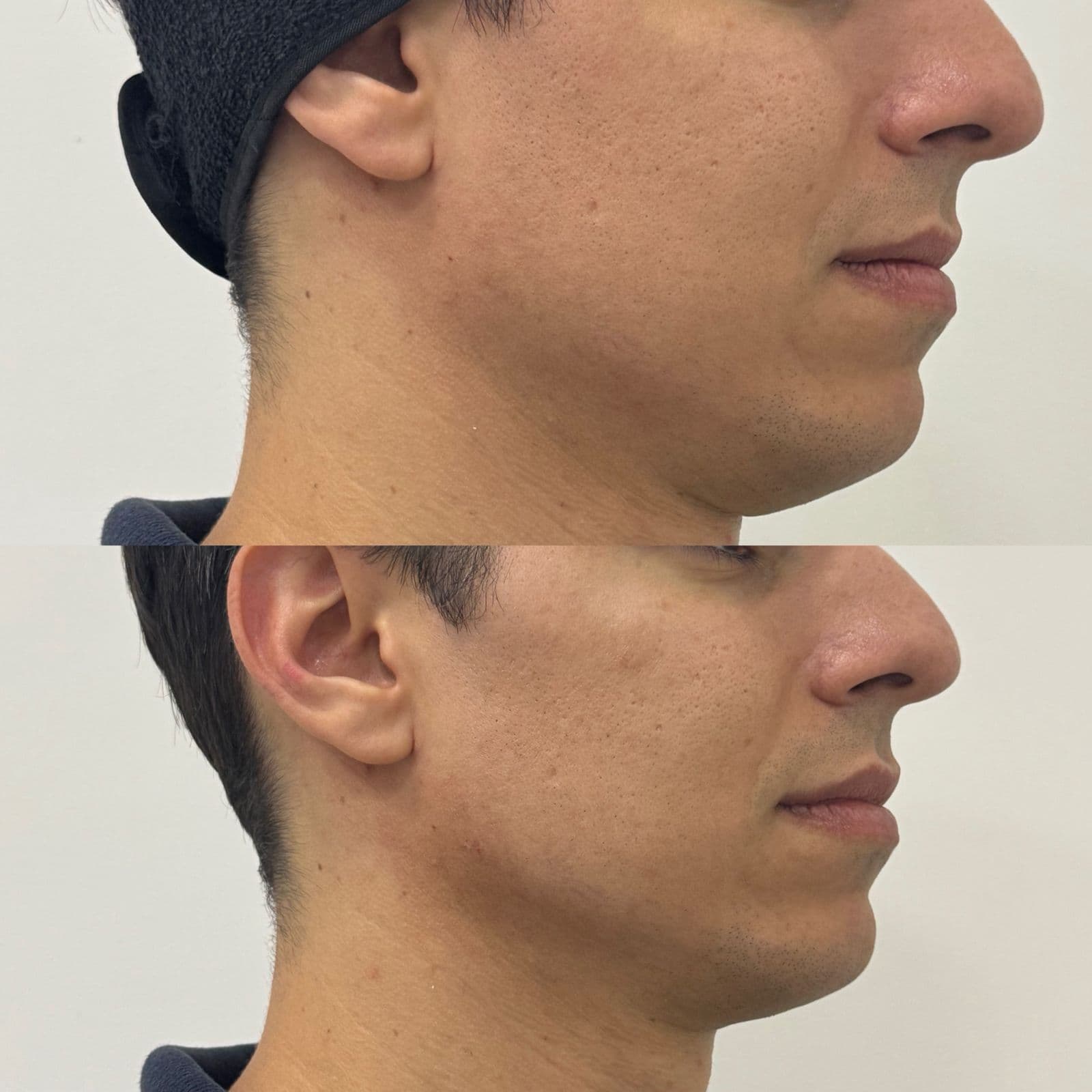 Antes e depois de Ultraformer para papada e definição de contorno mandibular
