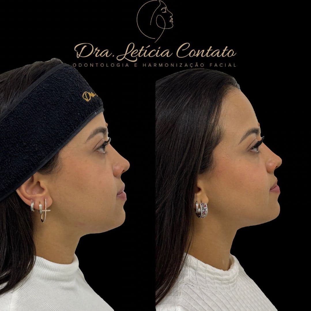 Antes e depois de Ultraformer para papada